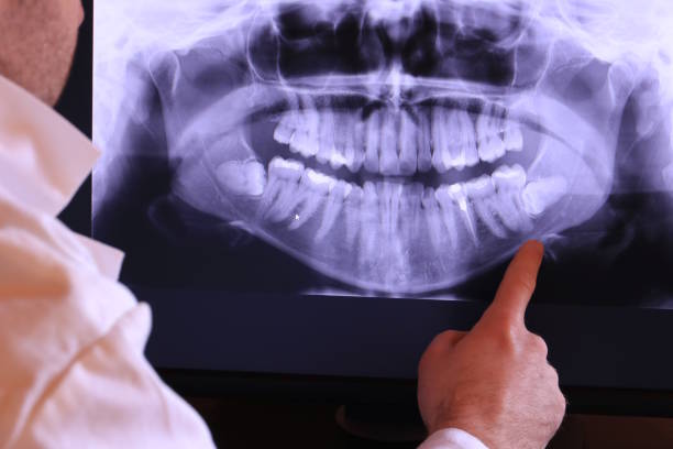 Best Dental Abscess Treatment in Phoenix, NY